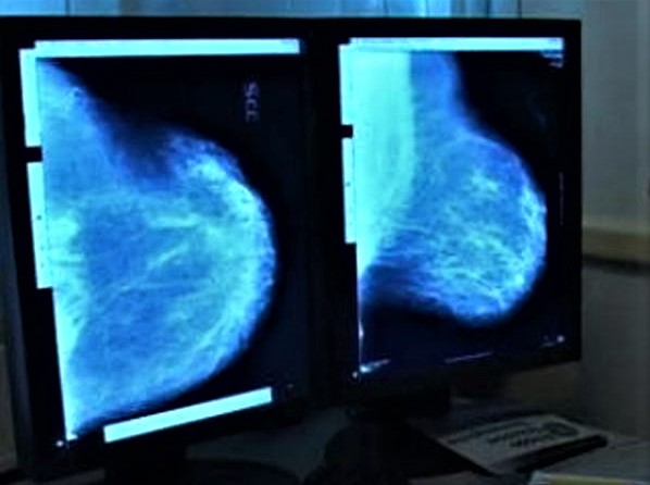 tumore al seno prevenzione (2)