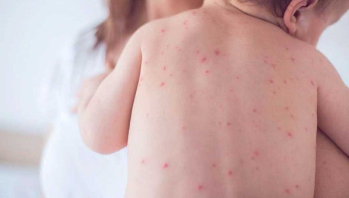 Un bambino di spalle, affetto da morbillo, con le tipiche bolle rosse sul corpo